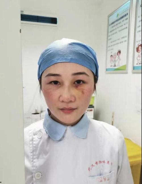 明星鼻子骨折,意外瞬间，美丽不再